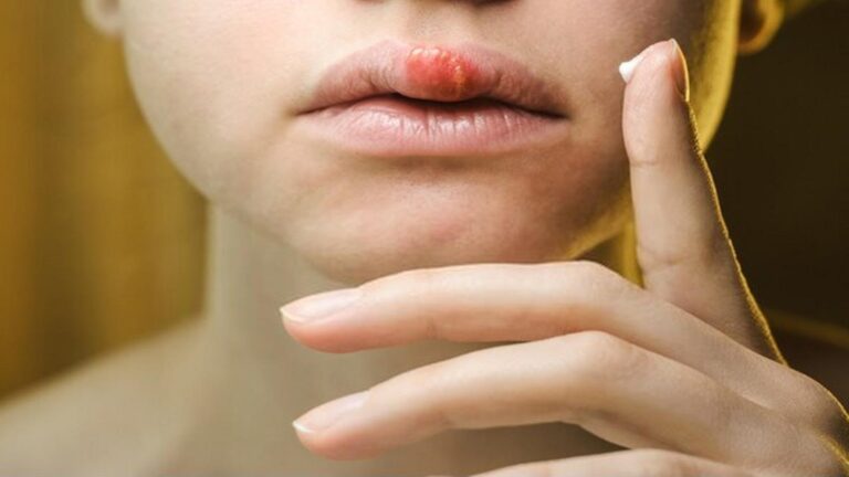 Cette astuce naturelle réduit votre herpès labial aussi vite que les médicaments…