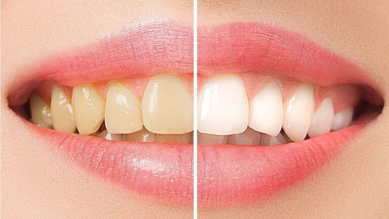 5 astuces naturelles pour des dents plus blanches et éclatantes !