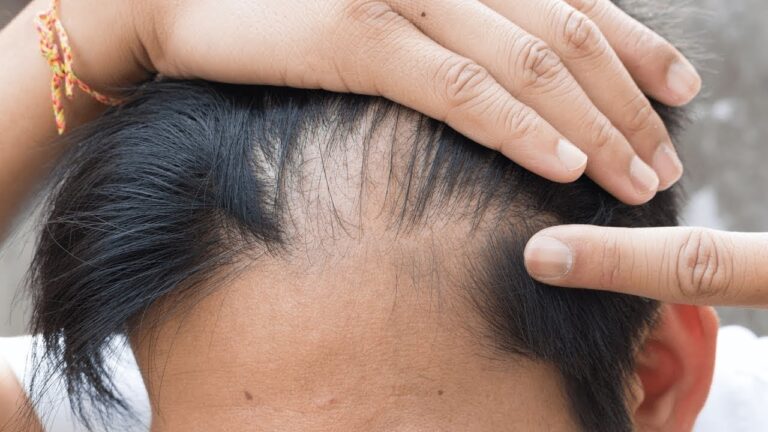 5 façons dont l&rsquo;huile de ricin transforme la santé de vos cheveux