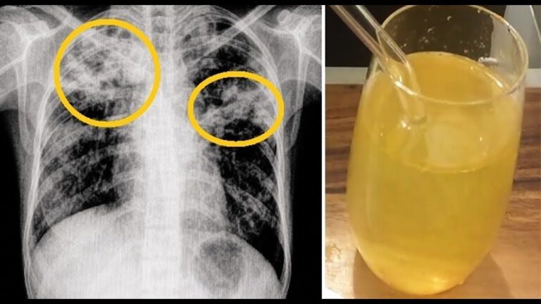 6 astuces pour éliminer le mucus et soulager rapidement gorge et poitrine
