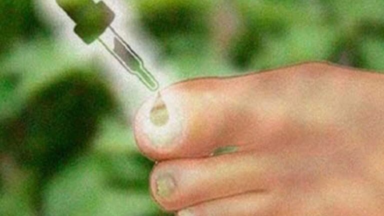 Éliminez le champignon des pieds en 3 étapes simples et efficaces !