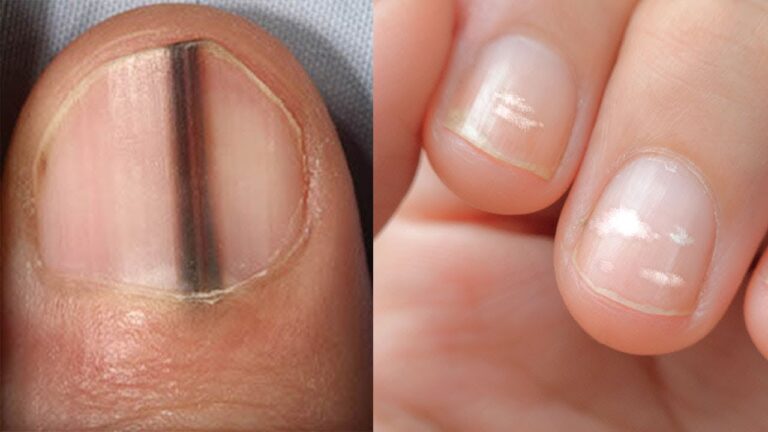 5 signes sur vos ongles à ne pas ignorer pour votre santé !