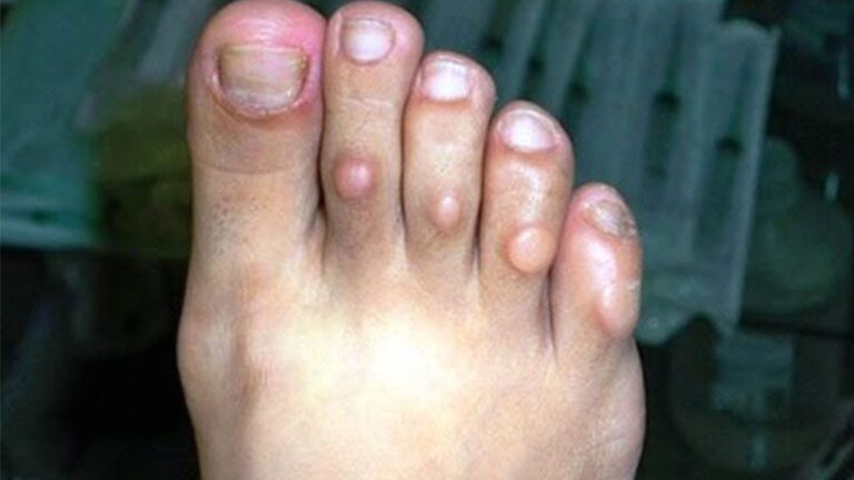 10 remèdes maison efficaces pour soulager les cors aux pieds naturellement !