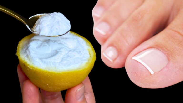 Éliminez l&rsquo;onychomycose en 3 étapes avec ce remède naturel 100% efficace !